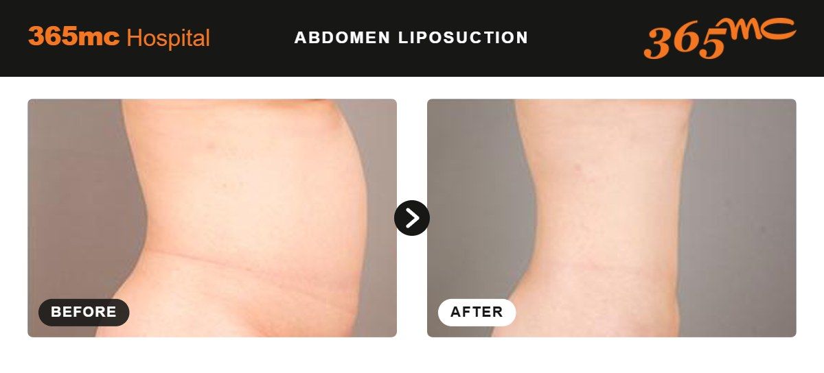 Abdomen liposuction before and after at 365mc Seoul, case 4