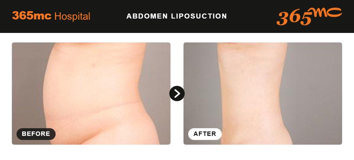 Abdomen liposuction before and after at 365mc Seoul, case 5