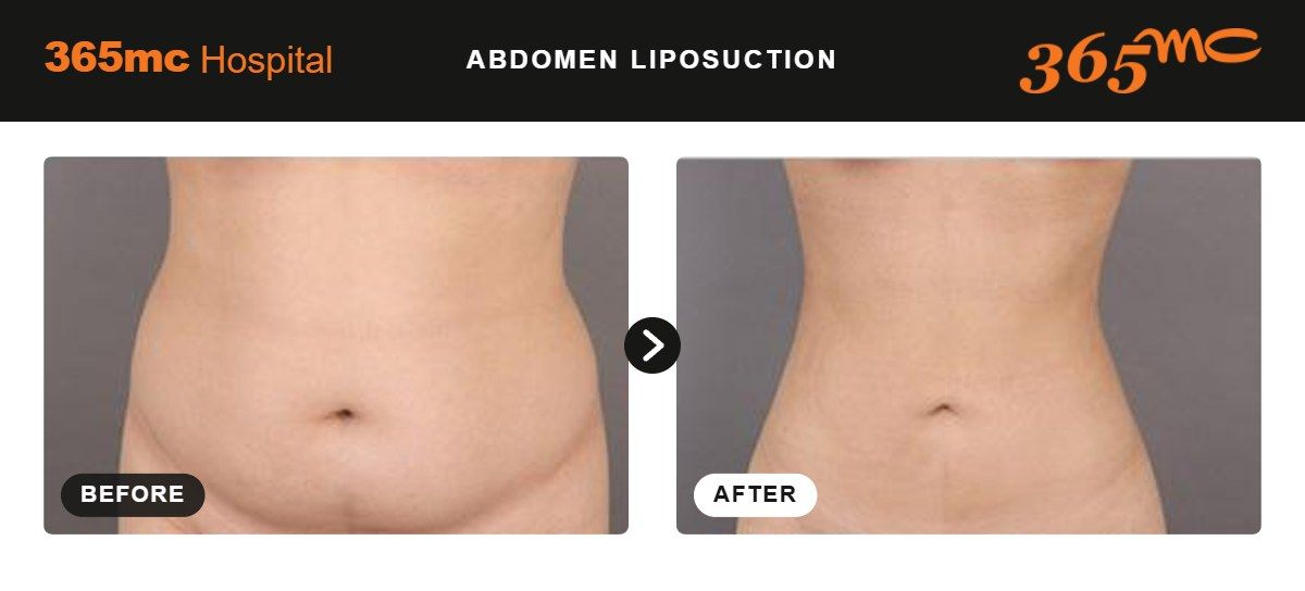 Abdomen liposuction before and after at 365mc Seoul, case 6