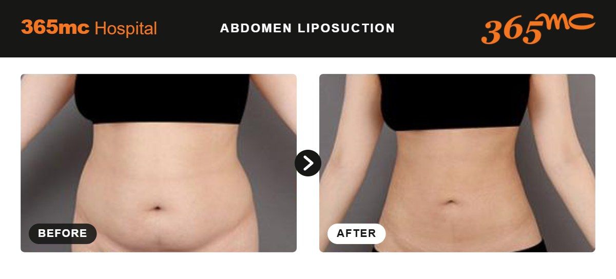 Abdomen liposuction before and after at 365mc Seoul, case 7