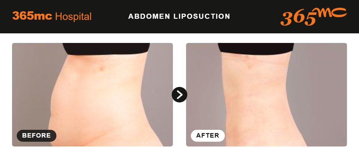 Abdomen liposuction before and after at 365mc Seoul, case 8
