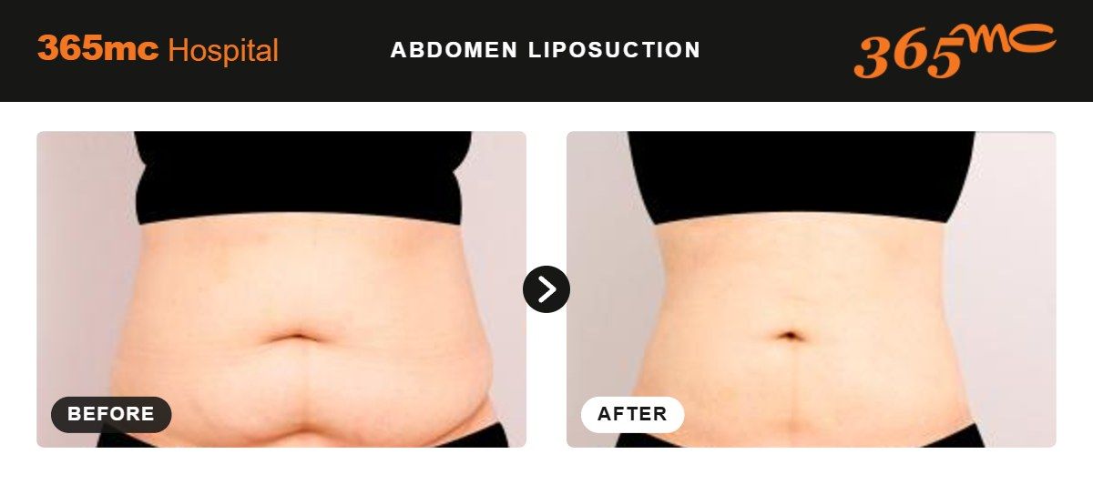 Abdomen liposuction before and after at 365mc Seoul, case 9