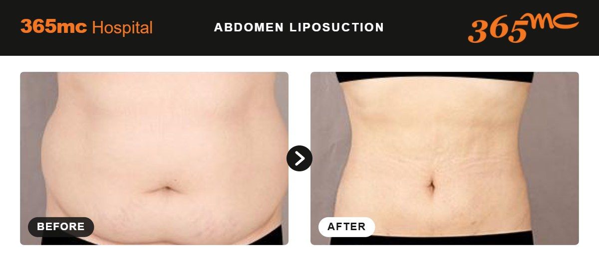 Abdomen liposuction before and after at 365mc Seoul, case 10