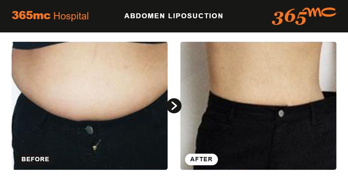 Abdomen liposuction before and after at 365mc Seoul, case 11