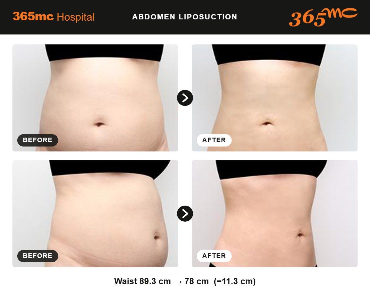Abdomen liposuction before and after at 365mc Seoul, case 12