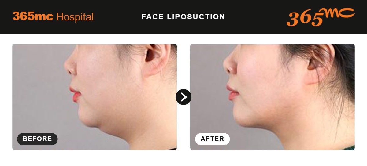 Face liposuction before and after at 365mc Seoul, case 4