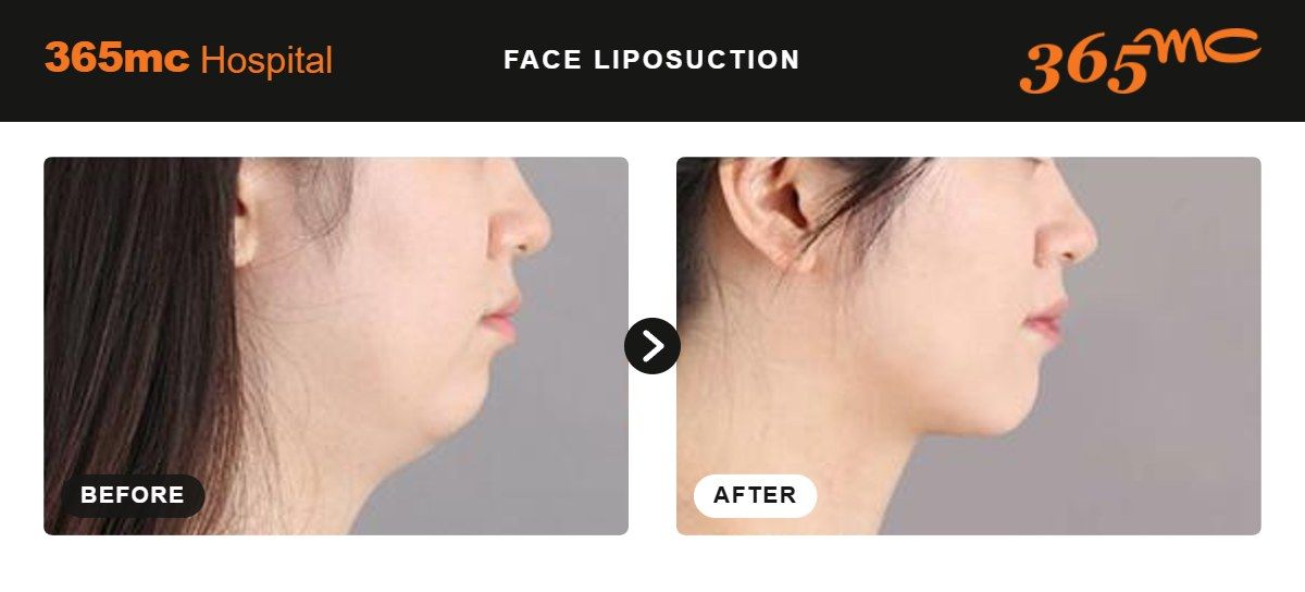 Face liposuction before and after at 365mc Seoul, case 5