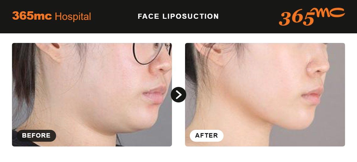 Face liposuction before and after at 365mc Seoul, case 6