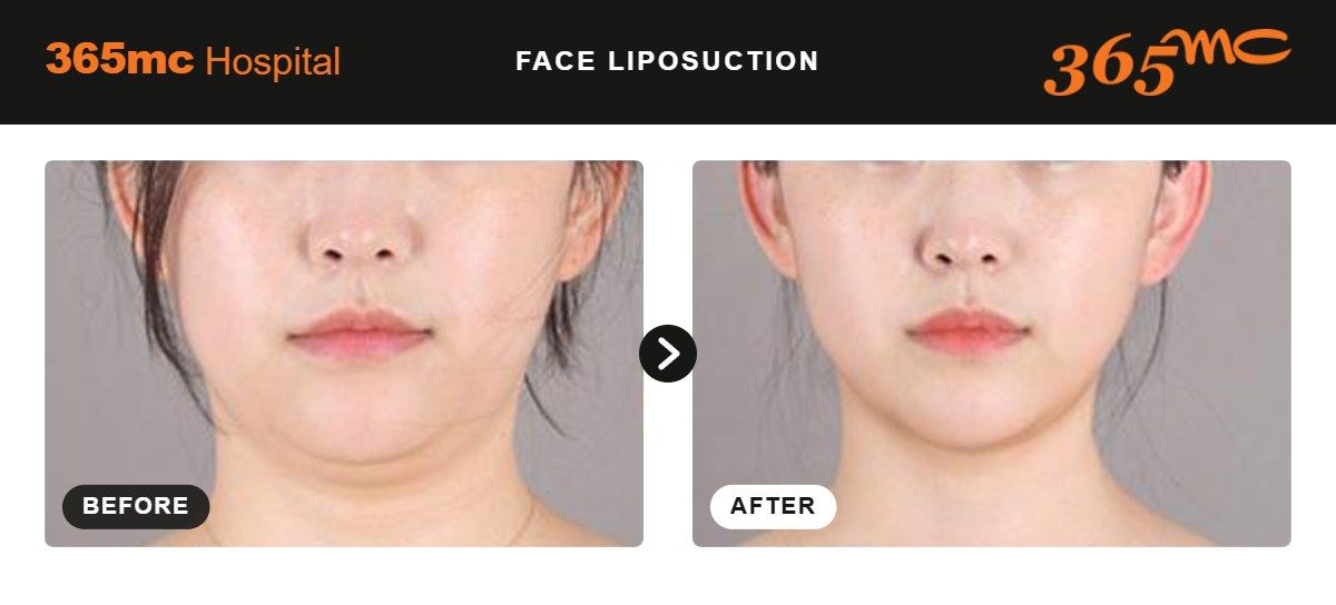 Face liposuction before and after at 365mc Seoul, case 7