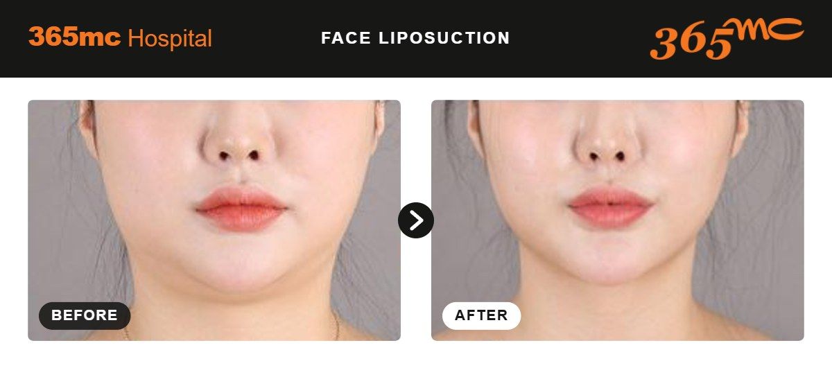 Face liposuction before and after at 365mc Seoul, case 8