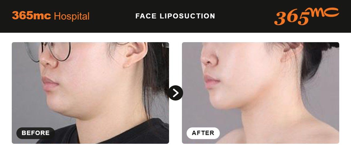 Face liposuction before and after at 365mc Seoul, case 9