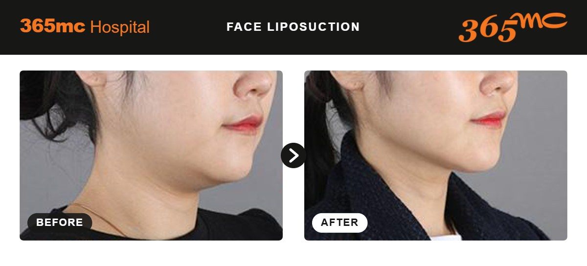 Face liposuction before and after at 365mc Seoul, case 10