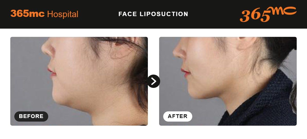 Face liposuction before and after at 365mc Seoul, case 11