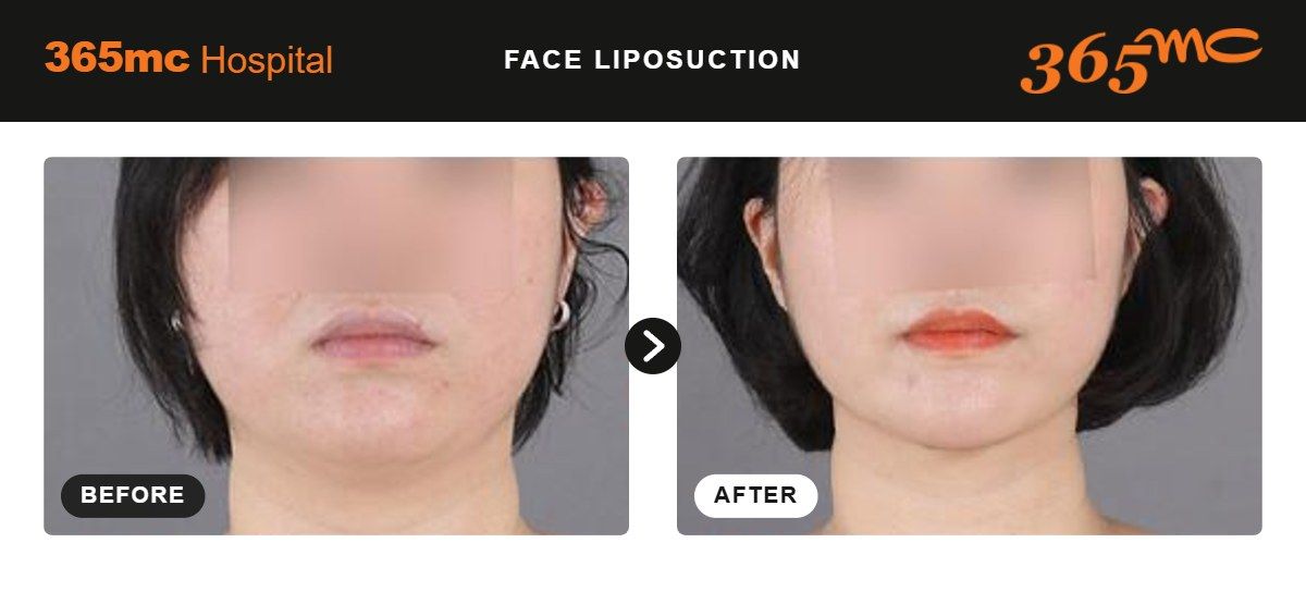 Face liposuction before and after at 365mc Seoul, case 12