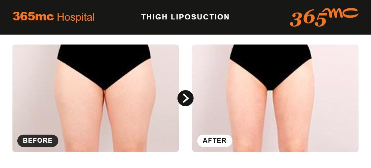 Thigh liposuction before and after at 365mc Seoul, case 4