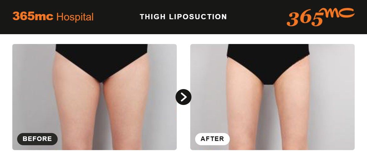 Thigh liposuction before and after at 365mc Seoul, case 5