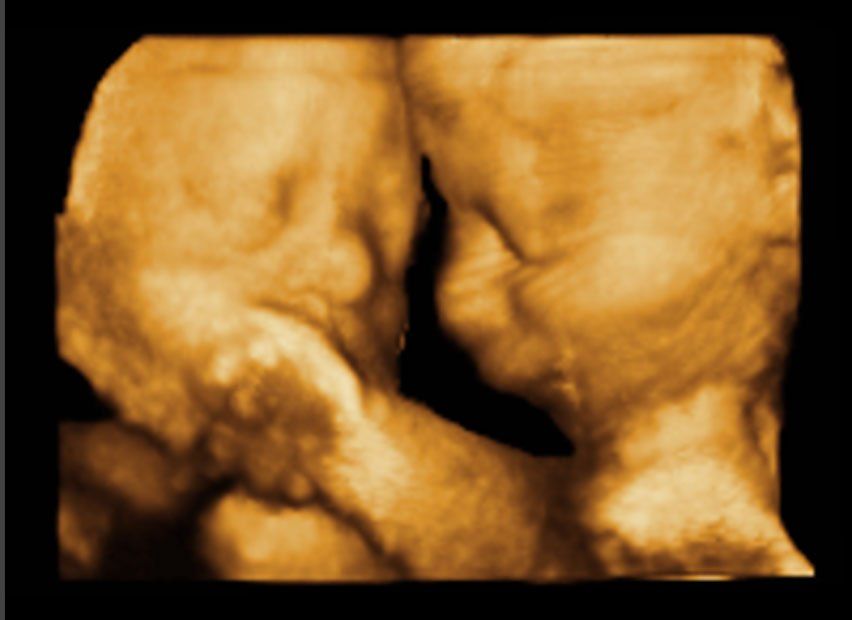 ecografia 2 gemelli in gestazione