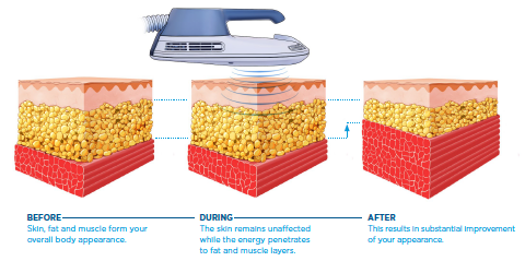 Muscle Definition — Emsculpt Process Graphic Representation in Columbus, OH