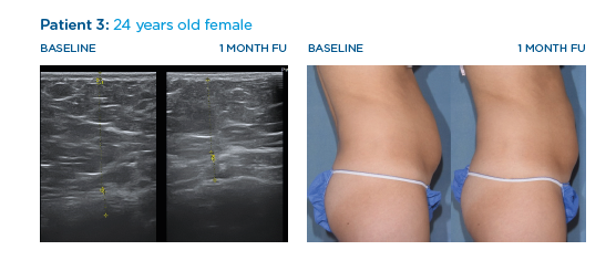 Muscle Effect — Simultaneous Fat And Muscle Effect Study in Columbus, OH