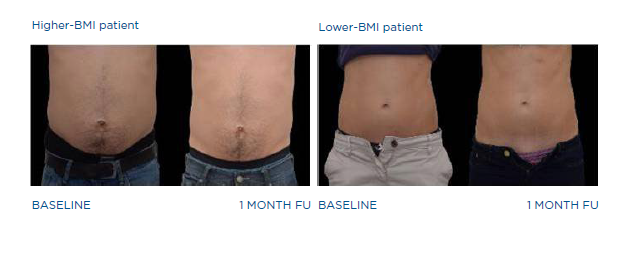 Fat — Emsculpt Results of BMI Patients in Columbus, OH