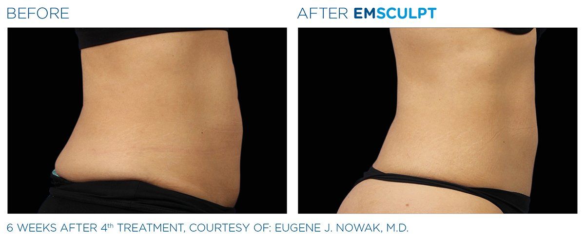 Chiseled Abs — 6 Weeks Treatment Results in Columbus, OH