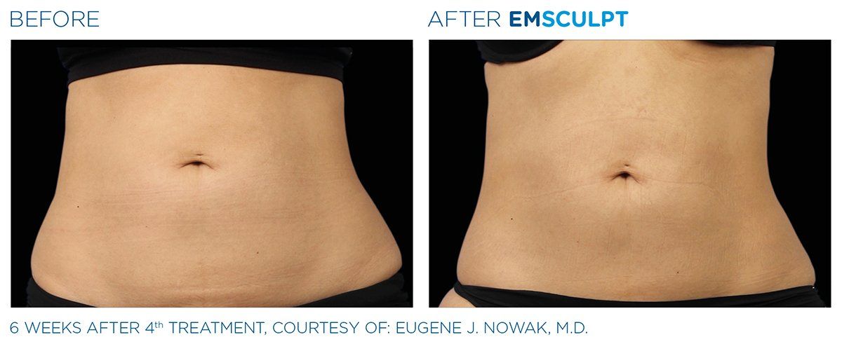 Dr Gina Mantor — Before And After Abdomen Results in Columbus, OH