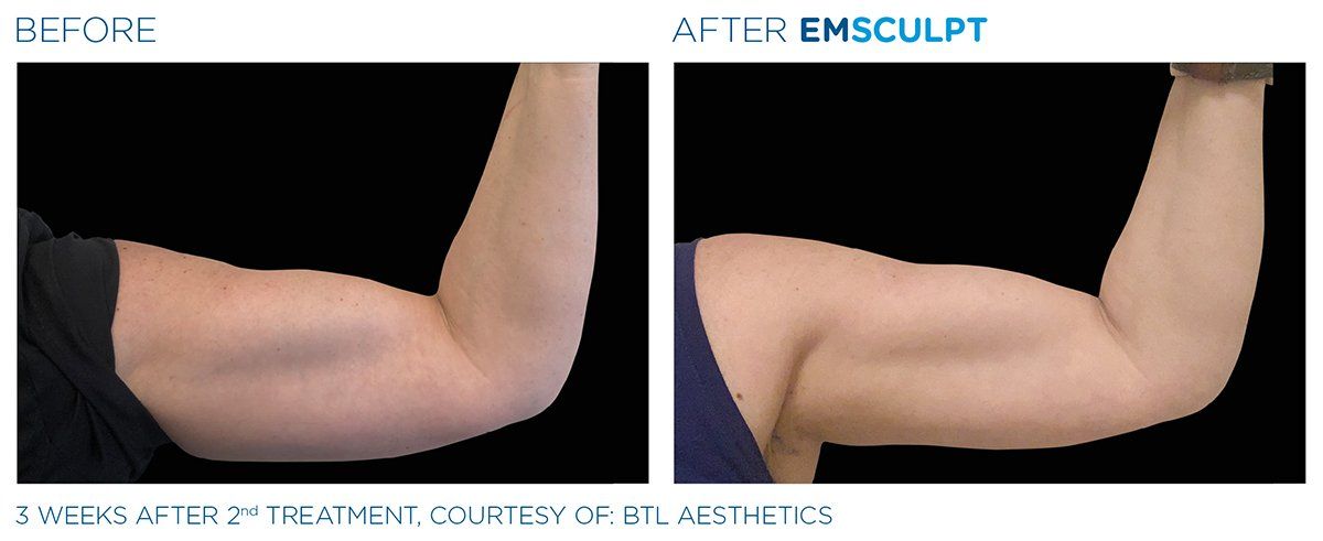 Biceps — Biceps After 3 Weeks Treatment in Columbus, OH