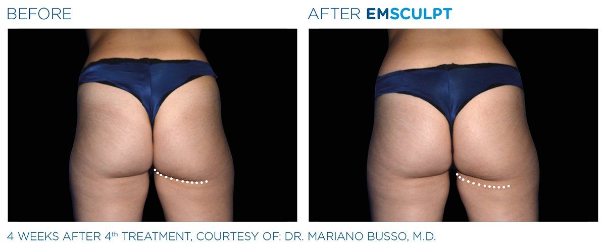 Buttocks Experts — Shaping Buttocks Treatment Results in Columbus, OH