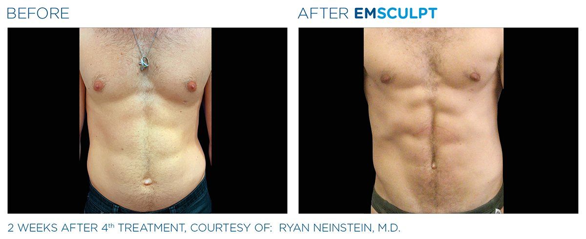Abs — Man Abs After 2 Weeks Treatment in Columbus, OH