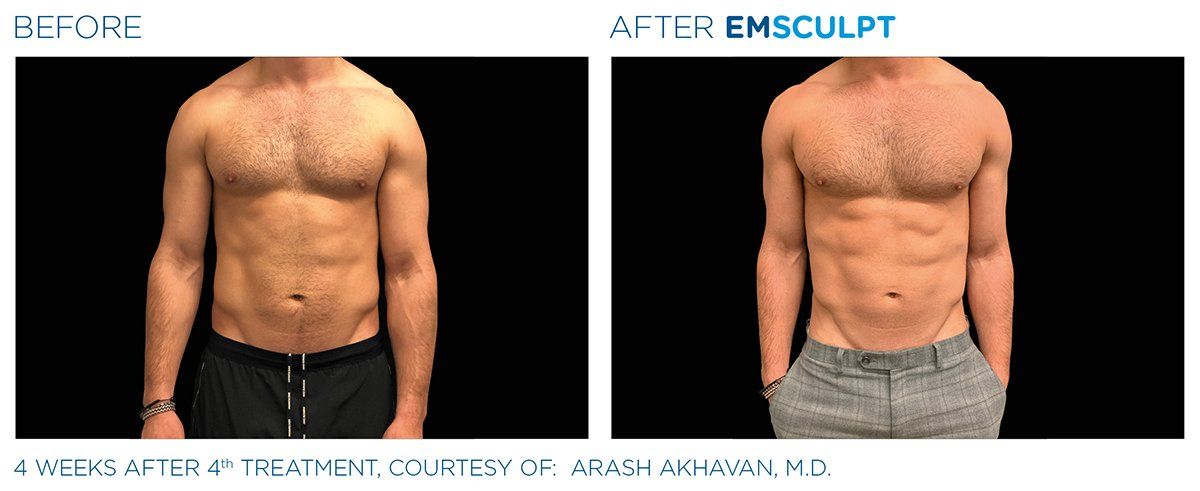 Abs Build — 4 Weeks Abs Treatment Results in Columbus, OH with Columbus EMSCULPT
