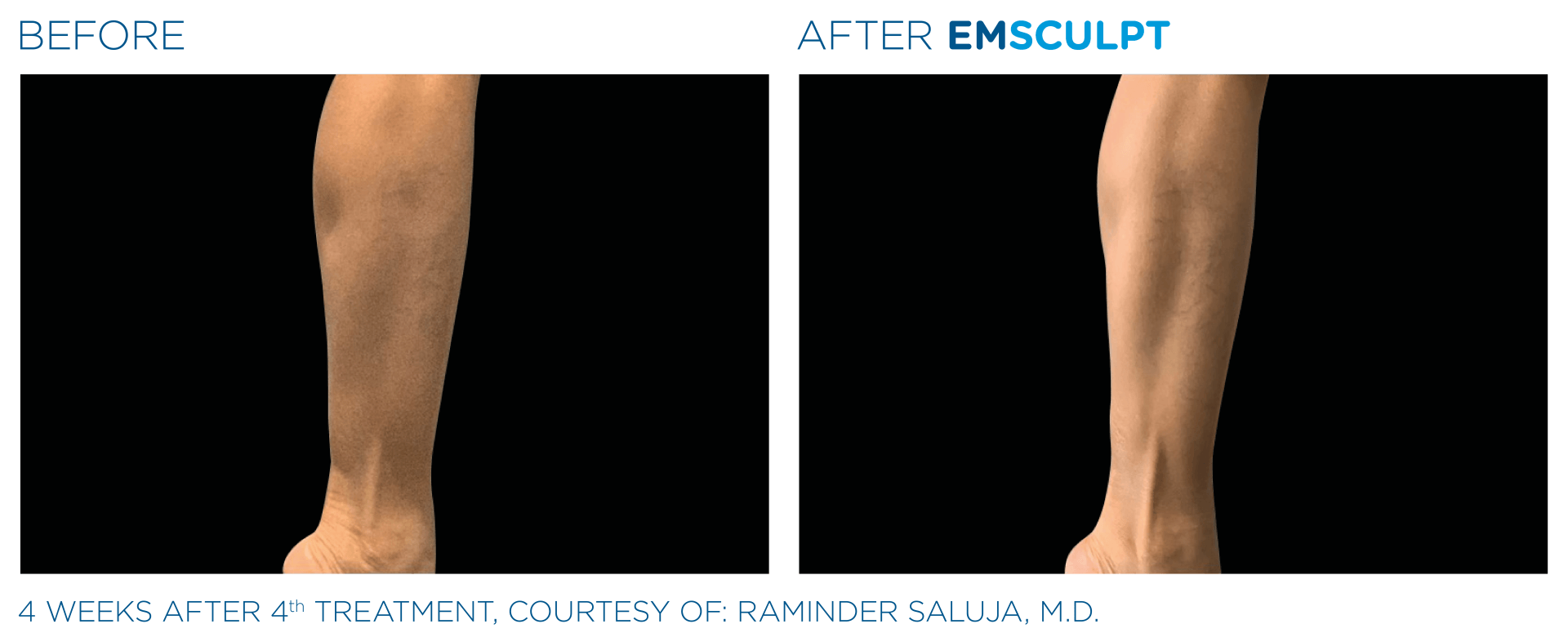 Fat — Emsculpt Calf Results of patients in Columbus, OH