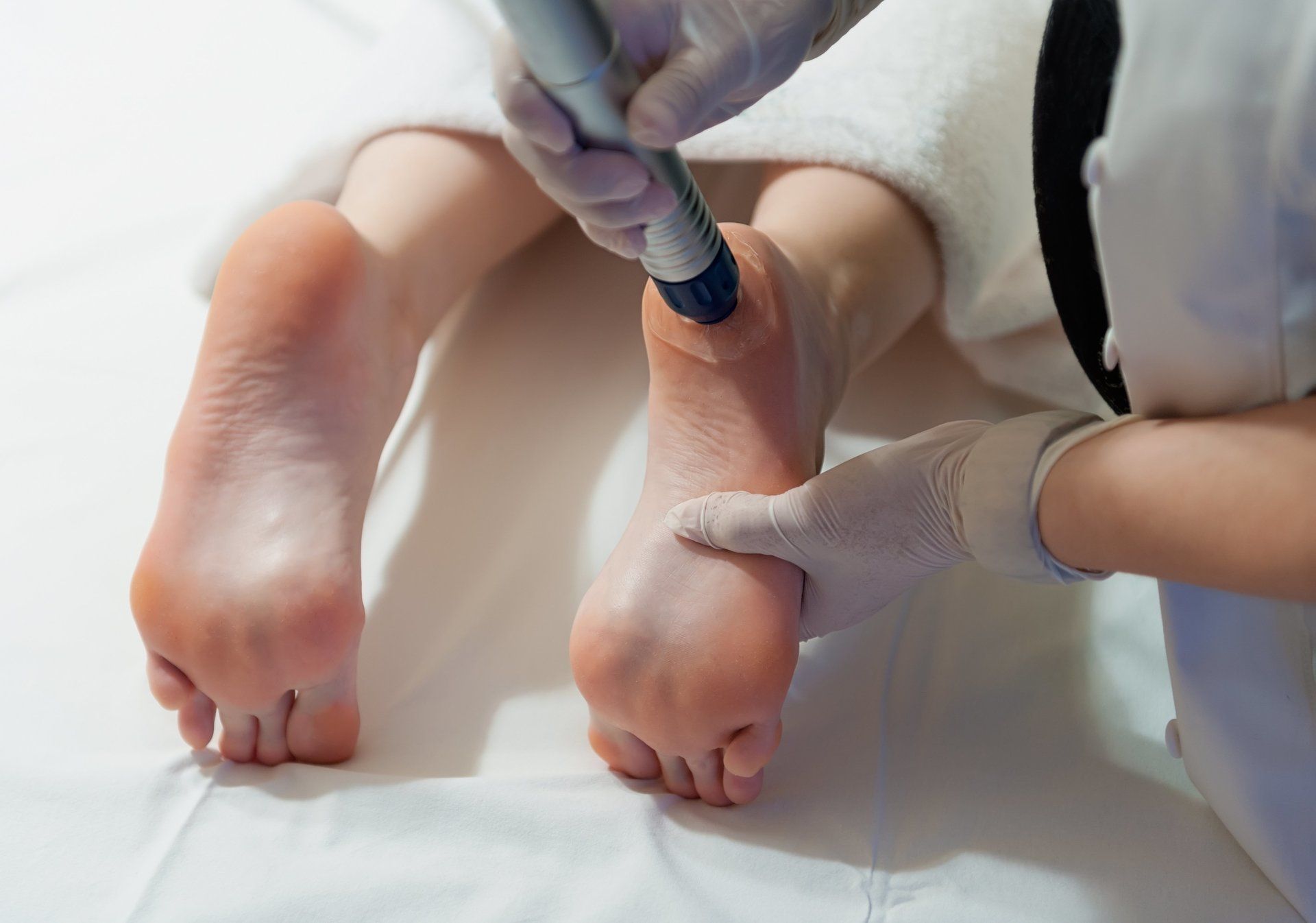 Callus Peels