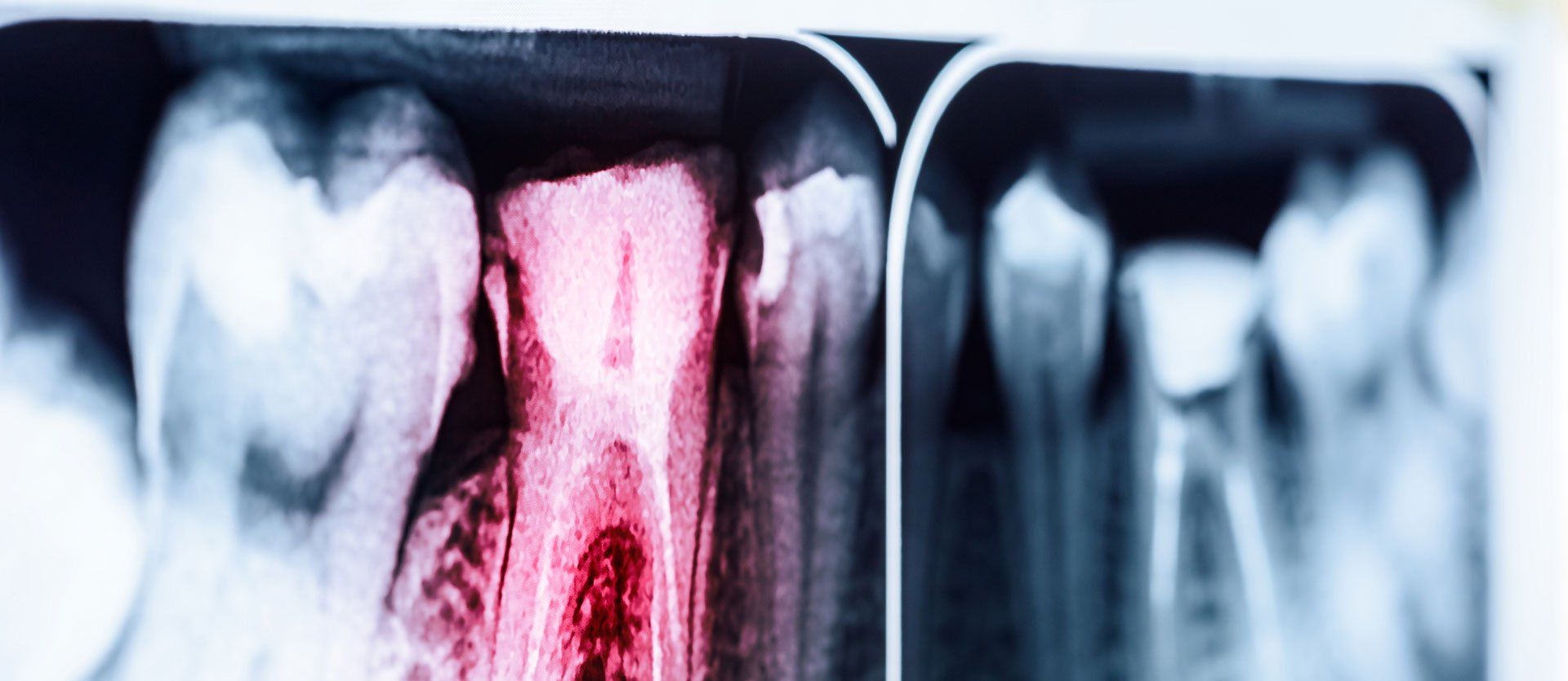 A close up of an x-ray of a tooth with a hole in it.