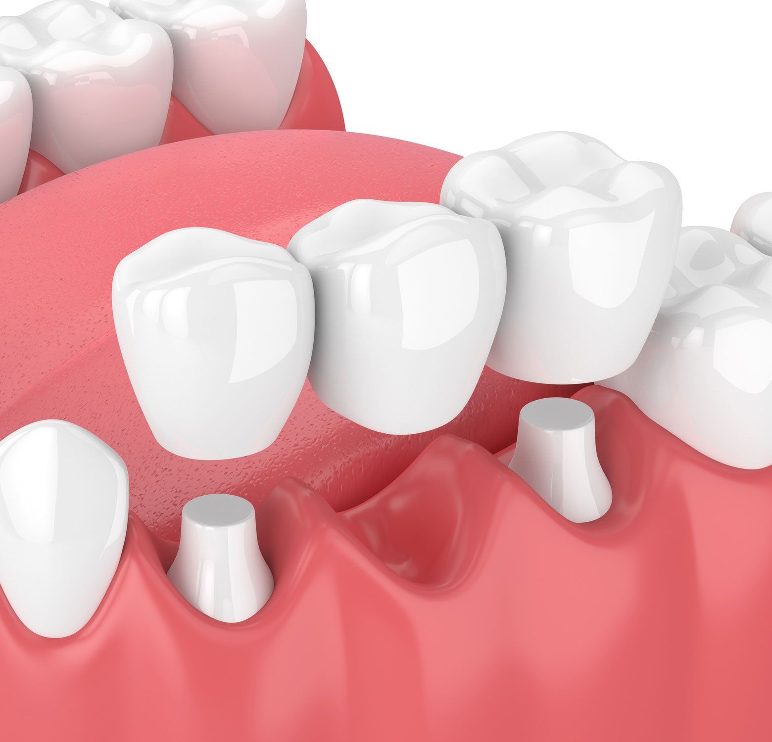 dental bridge