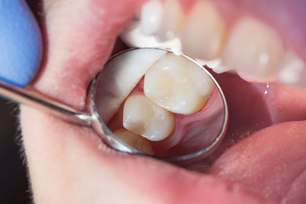 Fillings