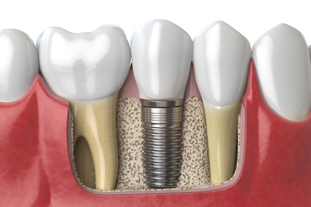 Implants