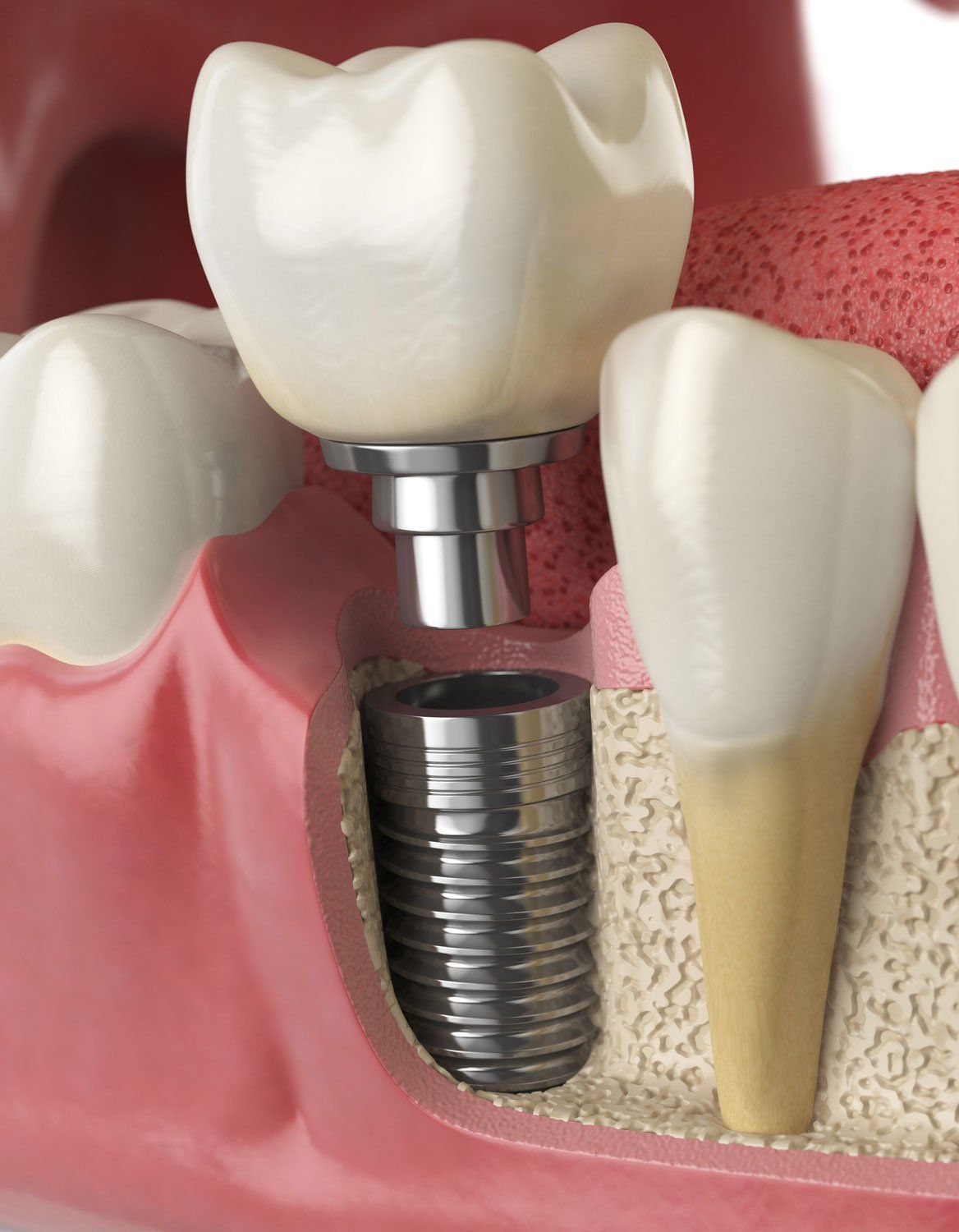 dental implant