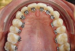 Braces Behind the Teeth
