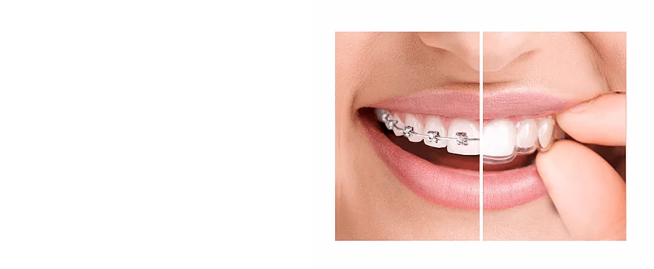 Braces vs clear aligners