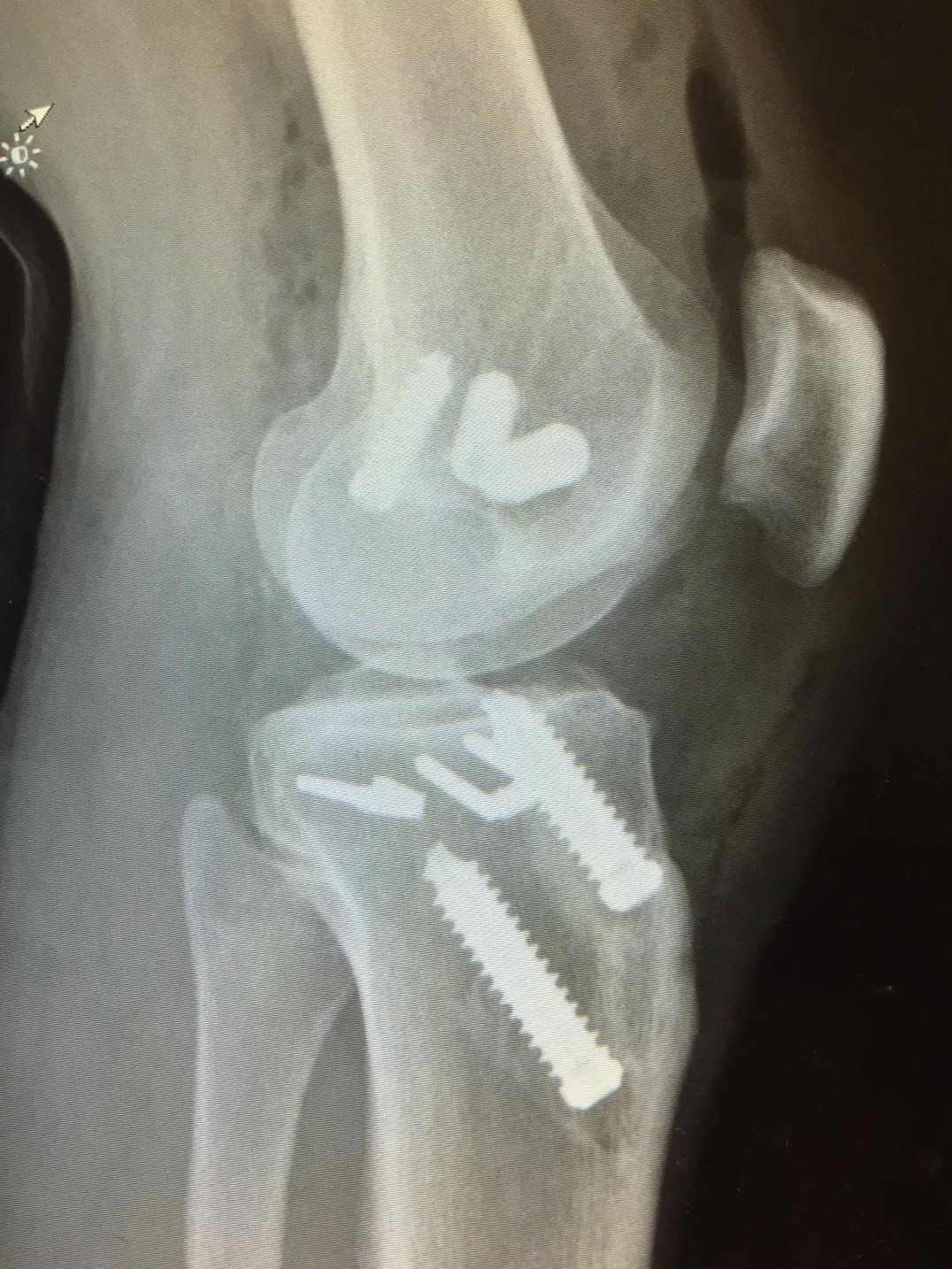 An x-ray of a knee with a screw in it.