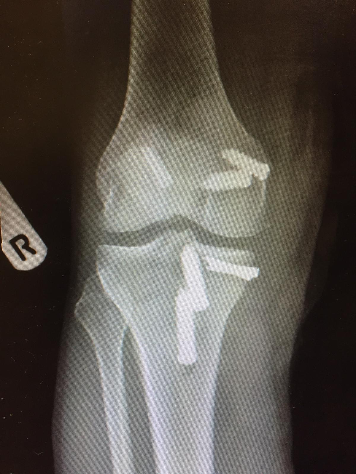 An x-ray of a knee with a screw in it.