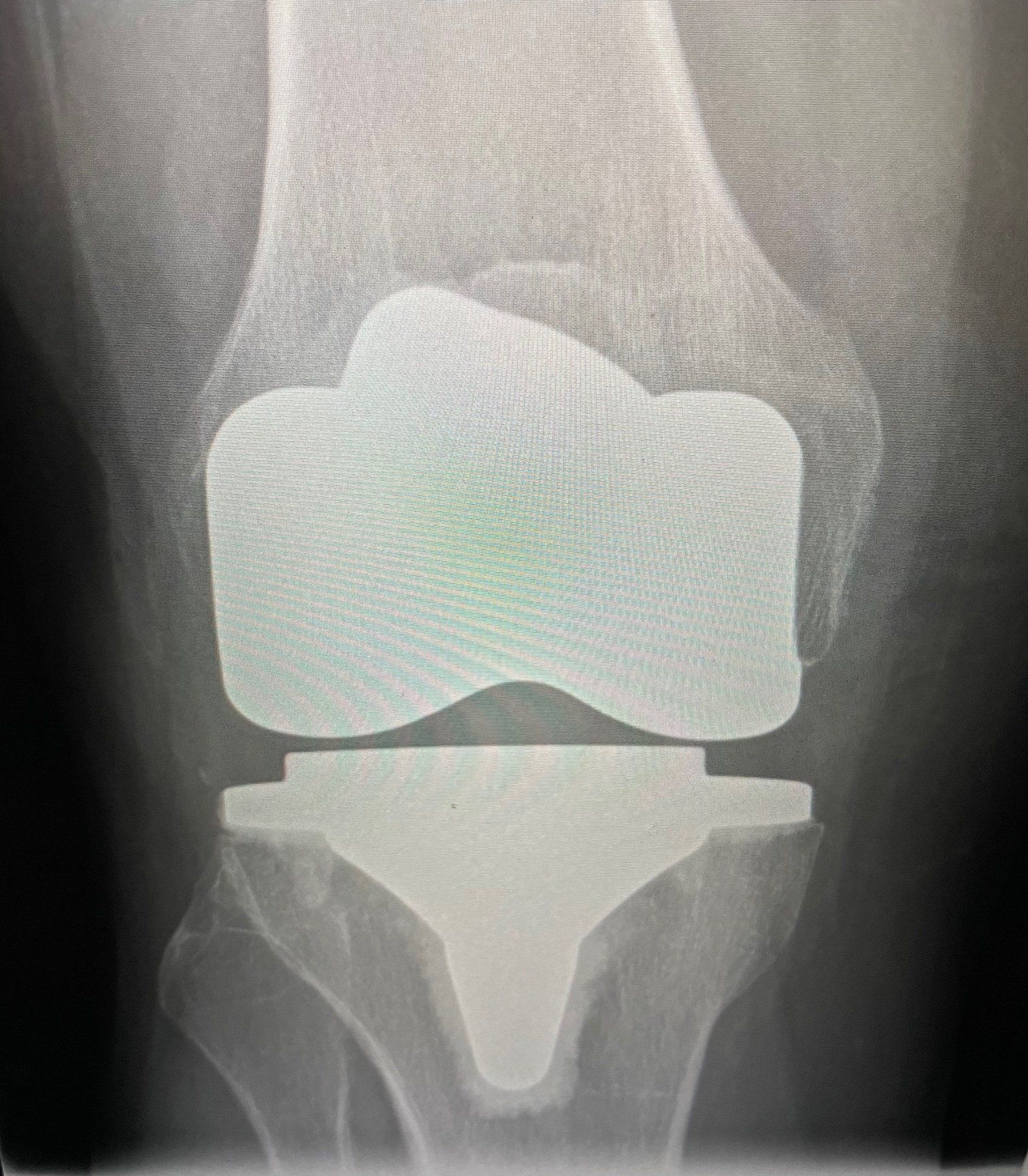 An x-ray of a knee with a knee replacement.