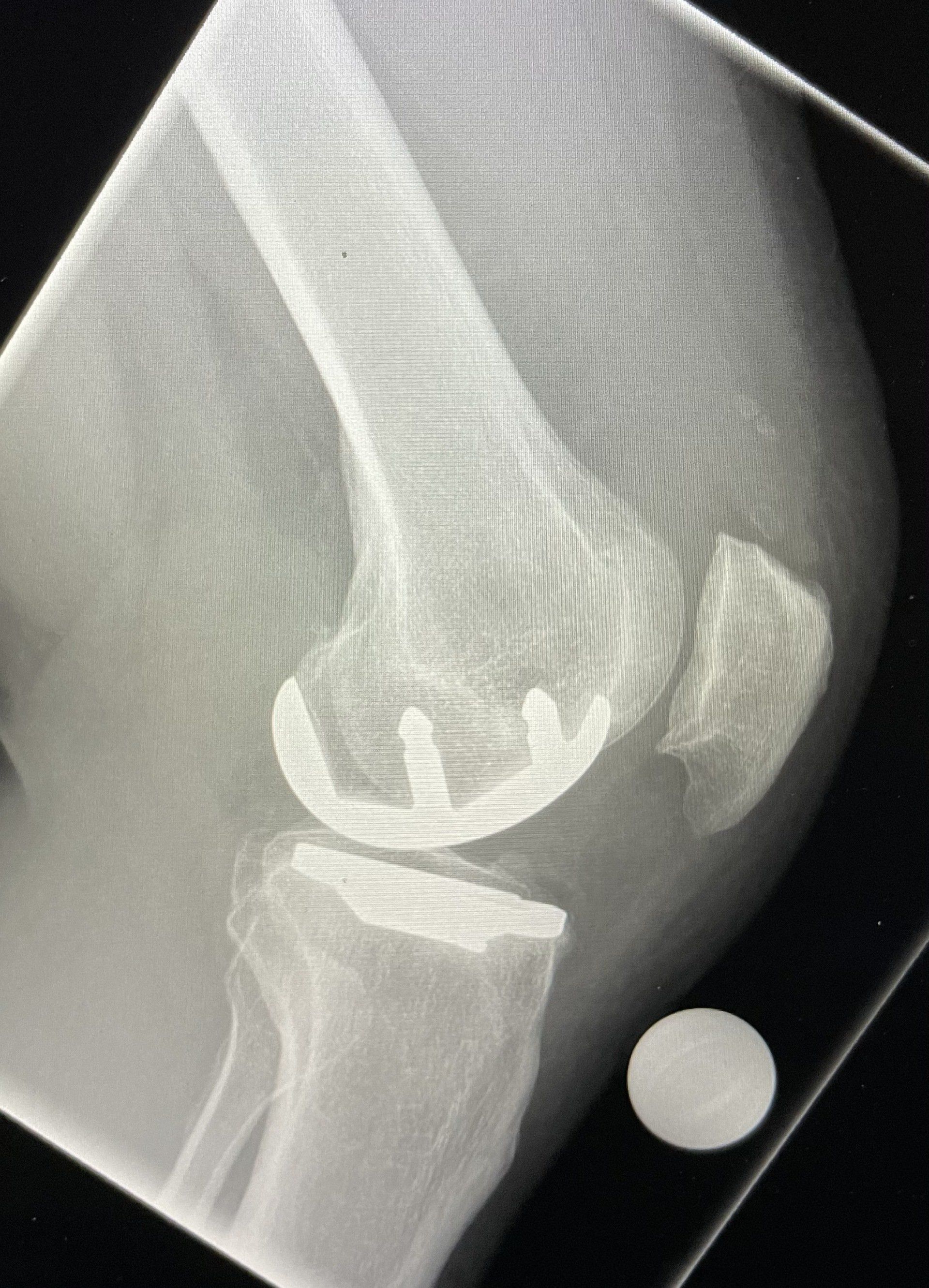 An x-ray of a knee with a prosthetic knee.