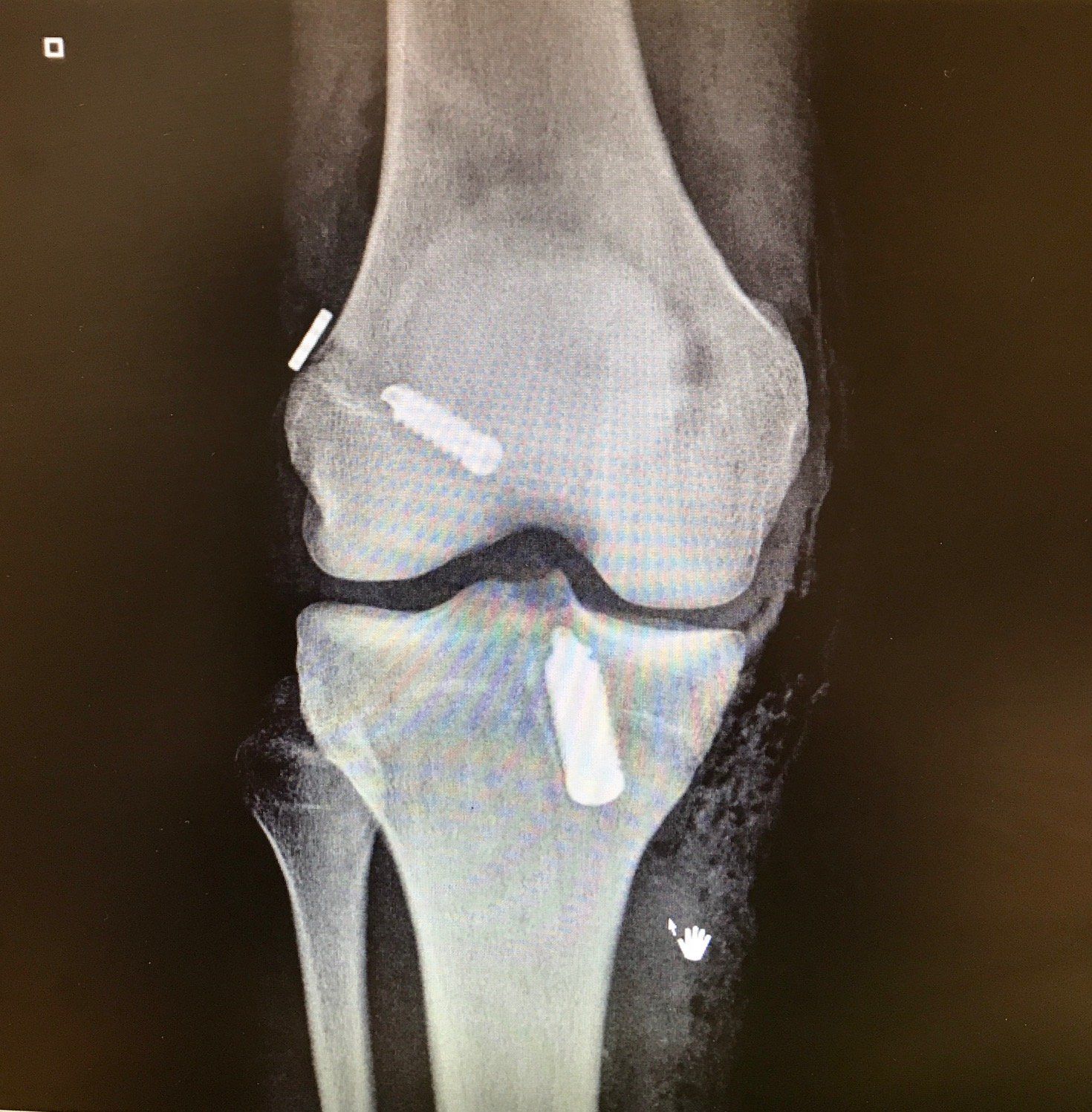 An x-ray of a knee with a screw in it.