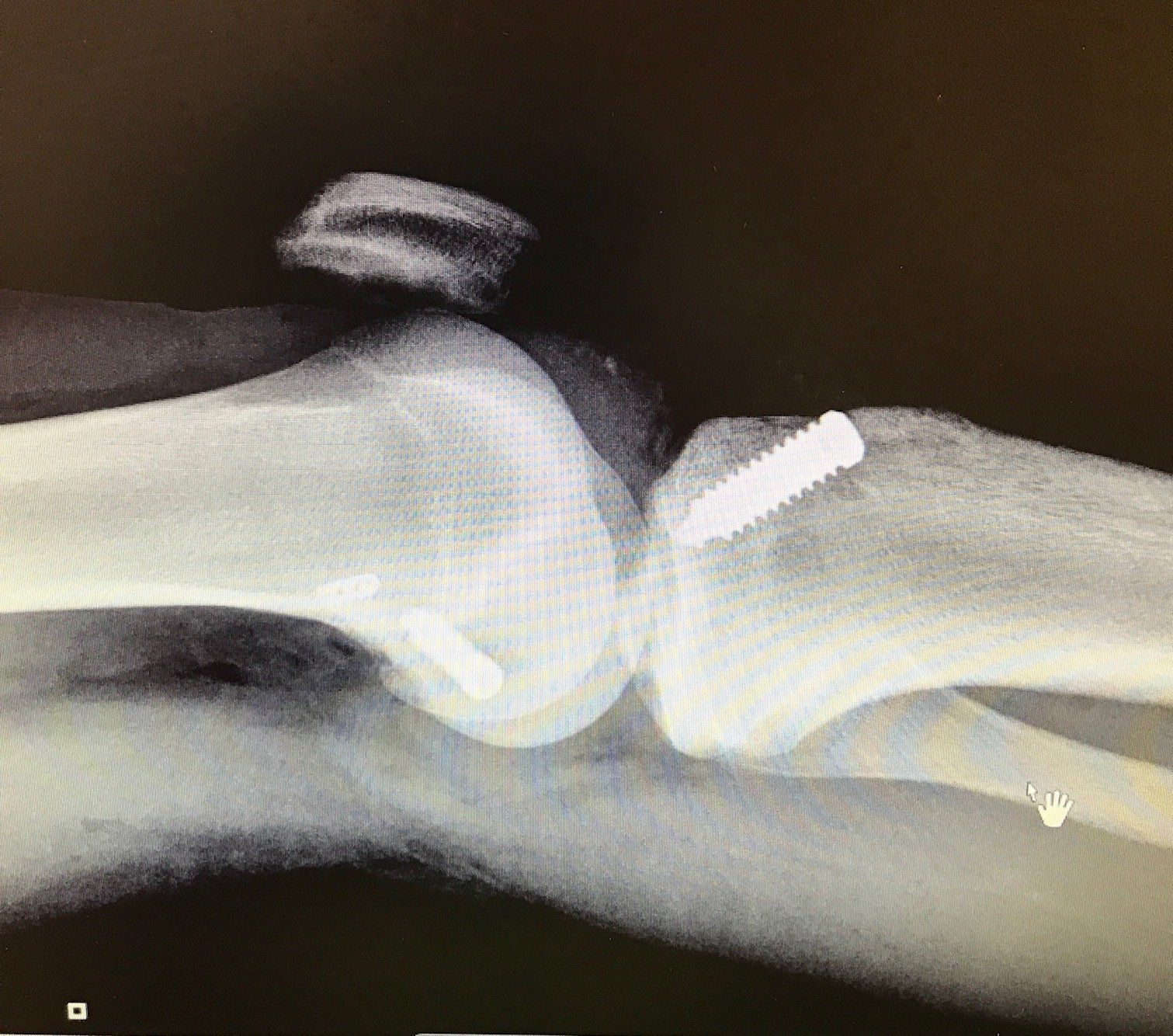 An x-ray of a knee with a screw in it.