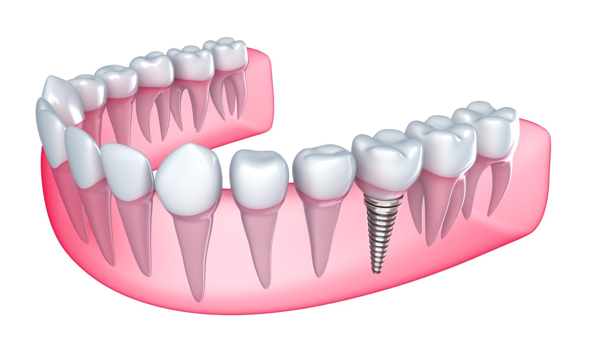 Dental Implants - Your Solution to Missing Teeth