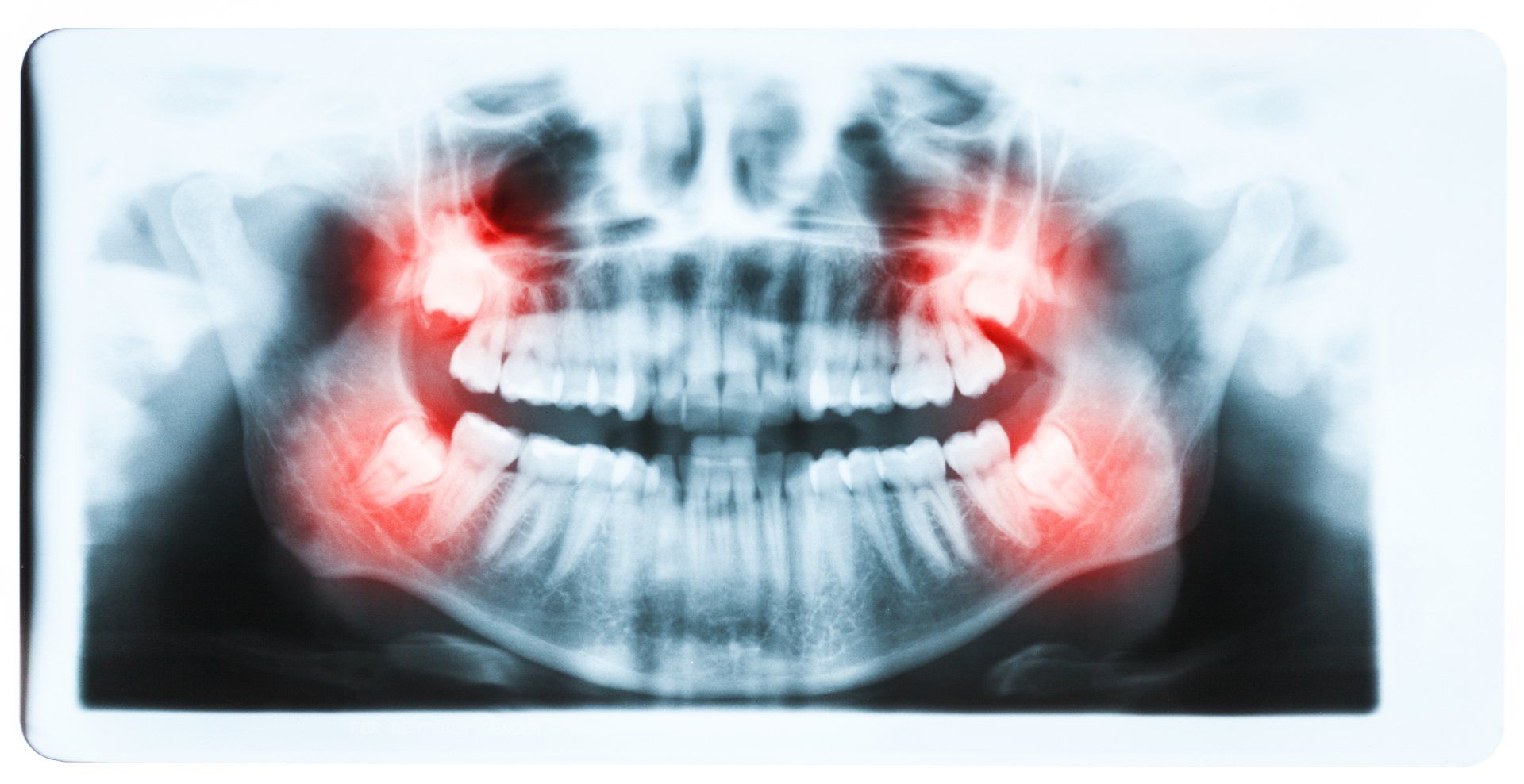 Tooth extraction