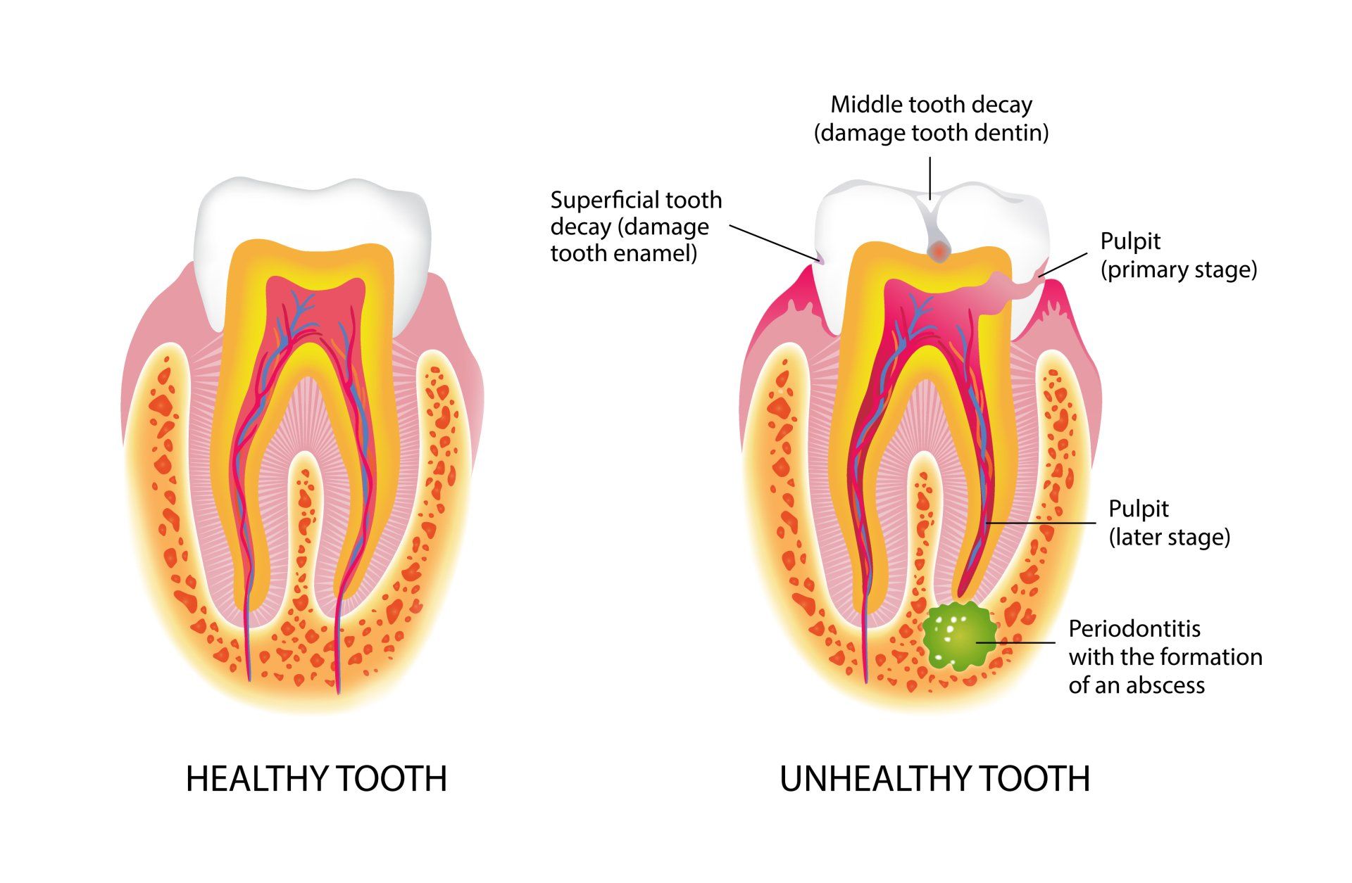Root Canal Therapy