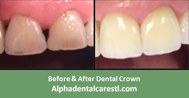 Before & After Dental Crown Example 1, Alpha Dental Care, St. Louis Before & After Dental Crown Example 1, Alpha Dental Care, St. Louis