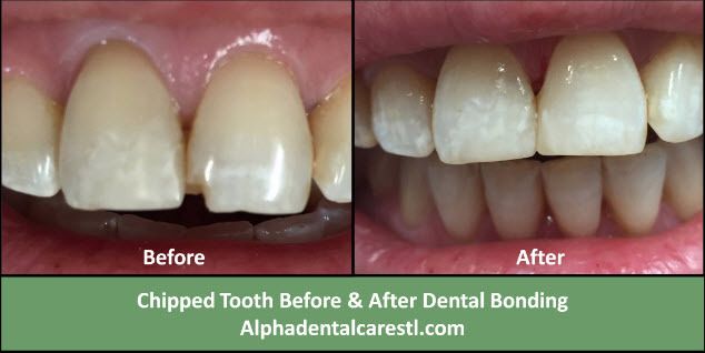Dental Bonding Before and After Example 2 Dental Bonding Before and After, Alpha Dental Care St. Louis
